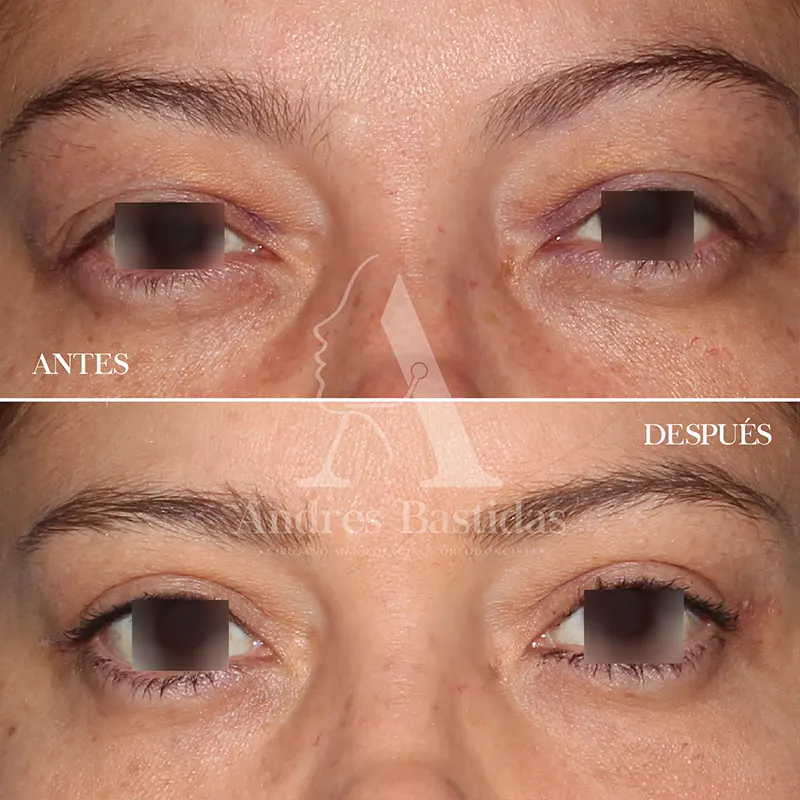 blefaroplastia-1