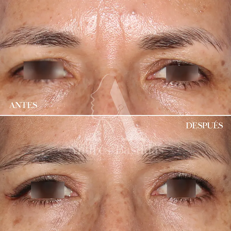 blefaroplastia-2