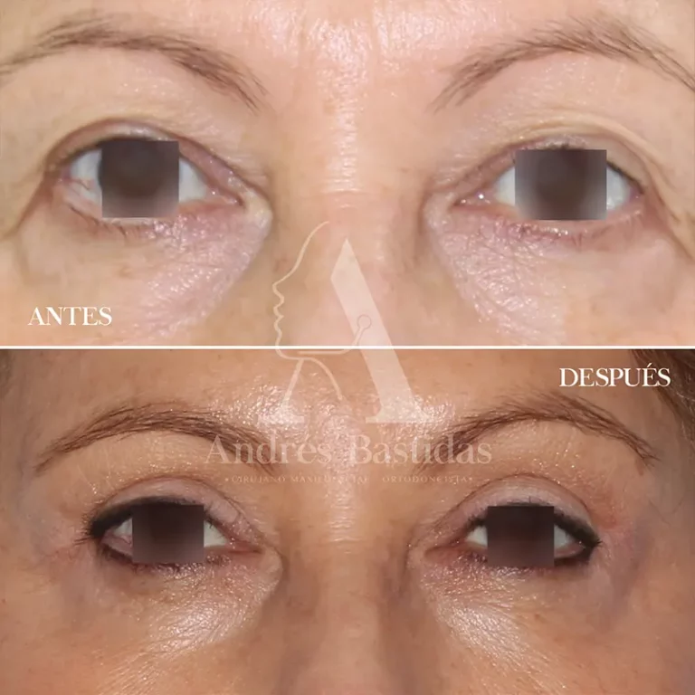 blefaroplastia-3