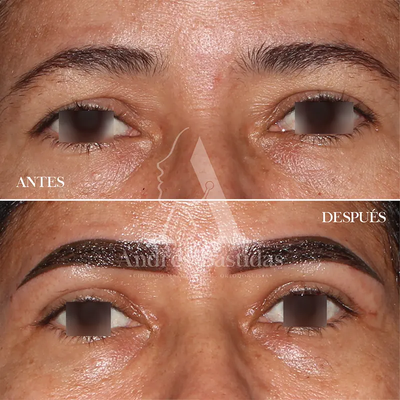 blefaroplastia-4