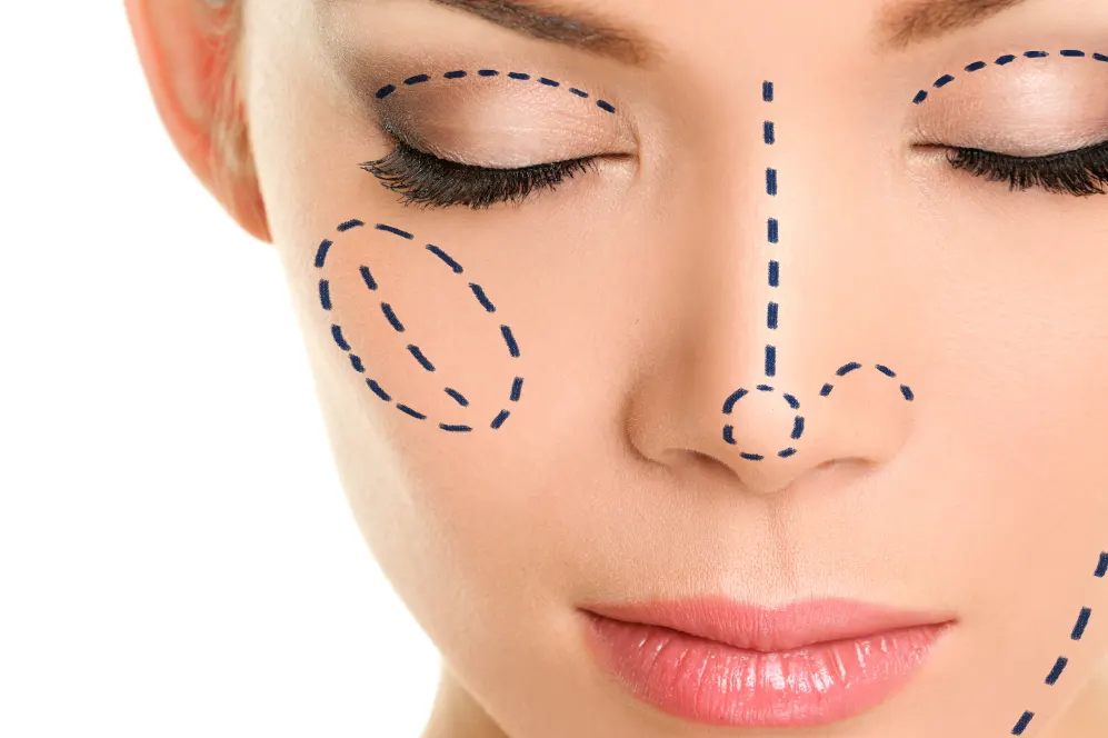 rinoplastia
