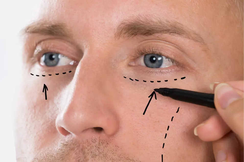 medidas-fotos-blefaroplastia-copia
